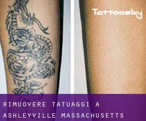 Rimuovere Tatuaggi a Ashleyville (Massachusetts)