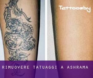 Rimuovere Tatuaggi a Ashrama
