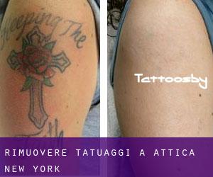 Rimuovere Tatuaggi a Attica (New York)