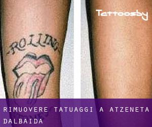 Rimuovere Tatuaggi a Atzeneta d'Albaida