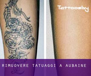 Rimuovere Tatuaggi a Aubaine