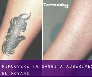 Rimuovere Tatuaggi a Auberives-en-Royans