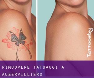 Rimuovere Tatuaggi a Aubervilliers