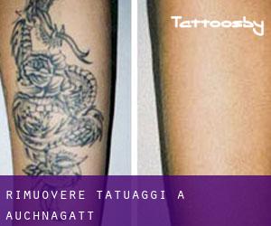 Rimuovere Tatuaggi a Auchnagatt