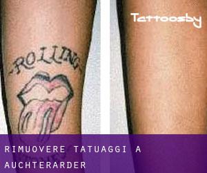 Rimuovere Tatuaggi a Auchterarder