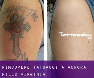 Rimuovere Tatuaggi a Aurora Hills (Virginia)