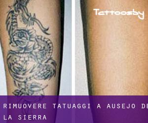 Rimuovere Tatuaggi a Ausejo de la Sierra