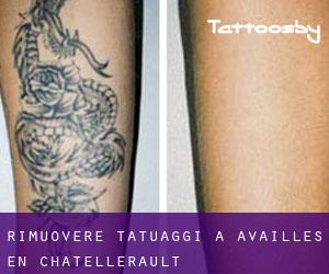 Rimuovere Tatuaggi a Availles-en-Châtellerault