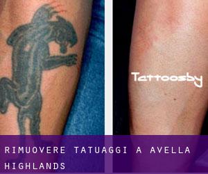 Rimuovere Tatuaggi a Avella Highlands