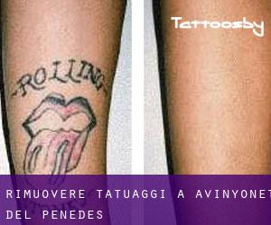 Rimuovere Tatuaggi a Avinyonet del Penedès
