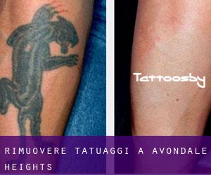 Rimuovere Tatuaggi a Avondale Heights