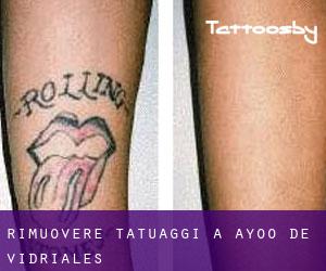 Rimuovere Tatuaggi a Ayoó de Vidriales