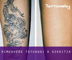 Rimuovere Tatuaggi a Azkoitia