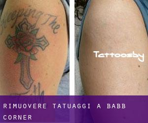 Rimuovere Tatuaggi a Babb Corner