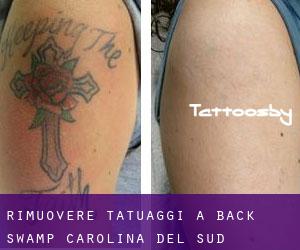 Rimuovere Tatuaggi a Back Swamp (Carolina del Sud)