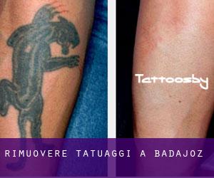 Rimuovere Tatuaggi a Badajoz