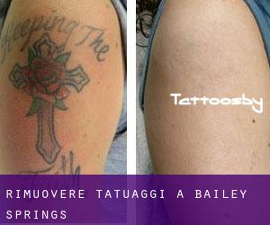 Rimuovere Tatuaggi a Bailey Springs