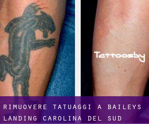 Rimuovere Tatuaggi a Baileys Landing (Carolina del Sud)