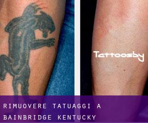 Rimuovere Tatuaggi a Bainbridge (Kentucky)