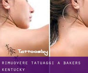 Rimuovere Tatuaggi a Bakers (Kentucky)