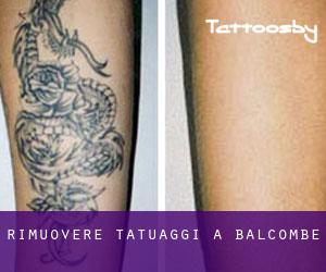 Rimuovere Tatuaggi a Balcombe