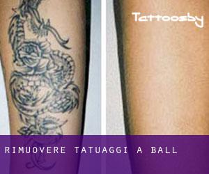 Rimuovere Tatuaggi a Ball