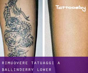 Rimuovere Tatuaggi a Ballinderry Lower