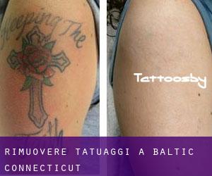 Rimuovere Tatuaggi a Baltic (Connecticut)