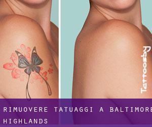 Rimuovere Tatuaggi a Baltimore Highlands
