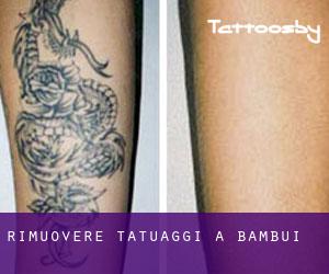 Rimuovere Tatuaggi a Bambuí