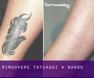 Rimuovere Tatuaggi a Bando
