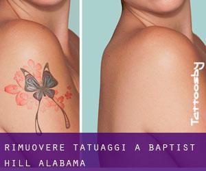 Rimuovere Tatuaggi a Baptist Hill (Alabama)