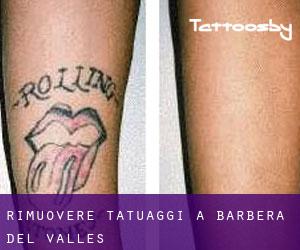 Rimuovere Tatuaggi a Barbera Del Valles