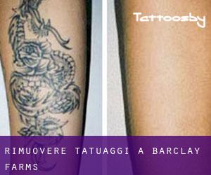 Rimuovere Tatuaggi a Barclay Farms