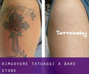 Rimuovere Tatuaggi a Bare Stone