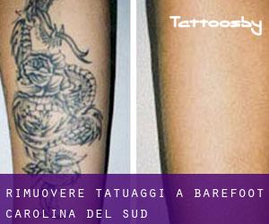 Rimuovere Tatuaggi a Barefoot (Carolina del Sud)