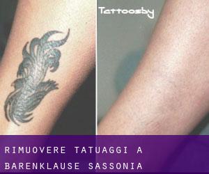 Rimuovere Tatuaggi a Bärenklause (Sassonia)