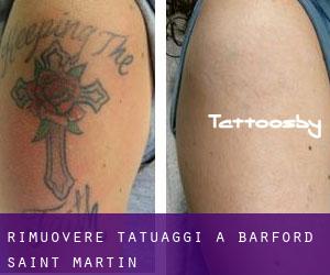 Rimuovere Tatuaggi a Barford Saint Martin