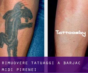 Rimuovere Tatuaggi a Barjac (Midi-Pirenei)