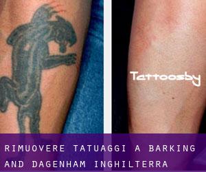 Rimuovere Tatuaggi a Barking and Dagenham (Inghilterra)