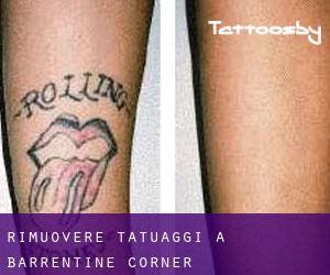 Rimuovere Tatuaggi a Barrentine Corner