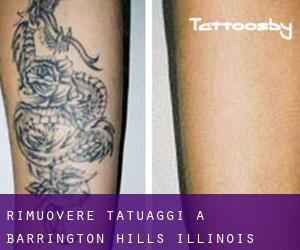 Rimuovere Tatuaggi a Barrington Hills (Illinois)