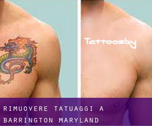 Rimuovere Tatuaggi a Barrington (Maryland)