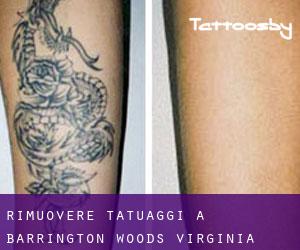Rimuovere Tatuaggi a Barrington Woods (Virginia)