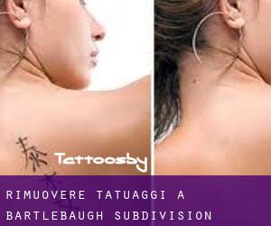 Rimuovere Tatuaggi a Bartlebaugh Subdivision