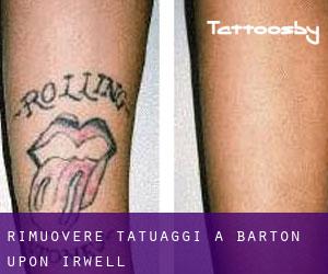Rimuovere Tatuaggi a Barton upon Irwell