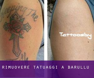 Rimuovere Tatuaggi a Barullu