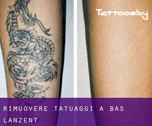 Rimuovere Tatuaggi a Bas Lanzent