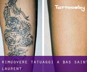 Rimuovere Tatuaggi a Bas-Saint-Laurent