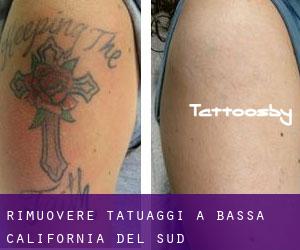 Rimuovere Tatuaggi a Bassa California del Sud